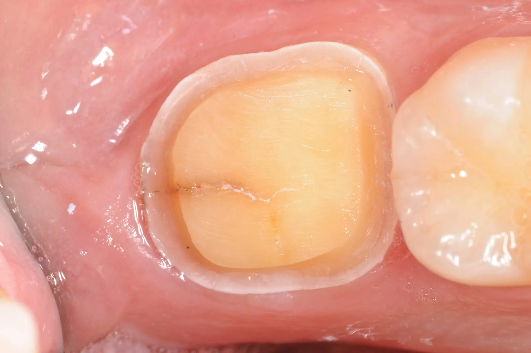 Cerec Crowns